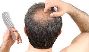 What are the home remedies for hair fall for men